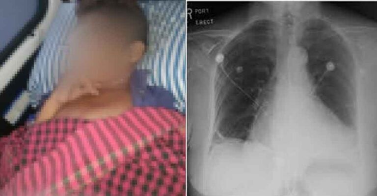 छत्तीसगढ़-बीजापुर में छात्र की मौत, दिल की कैविटी में मिला पानी