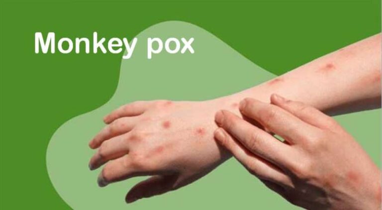मंकीपॉक्स का कहर: केरल में दूसरा केस मिलने पर केंद्र ने जारी की एडवाइजरी मंकीपॉक्स का कहर: केरल में दूसरा केस मिलने पर केंद्र ने जारी की एडवाइजरी