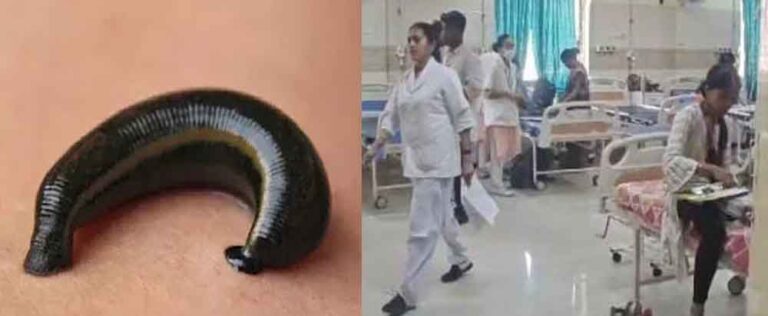 छत्तीसगढ़-कोरबा में चार साल की बच्ची के गुप्तांग में घुसी जोंक, डॉक्टरों ने सूझबूझ से निकाली बाहर छत्तीसगढ़-कोरबा में चार साल की बच्ची के गुप्तांग में घुसी जोंक, डॉक्टरों ने सूझबूझ से निकाली बाहर