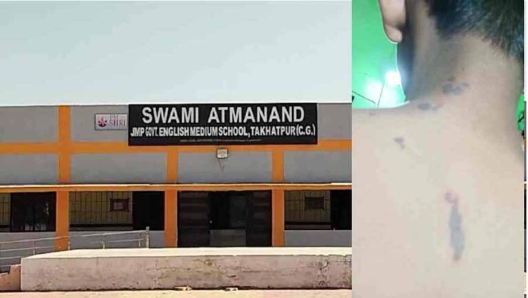 स्वामी आत्मानंद स्कूल तखतपुर में एसिड अटैक, बुरी तरह झुलसा छात्र स्वामी आत्मानंद स्कूल तखतपुर में एसिड अटैक, बुरी तरह झुलसा छात्र